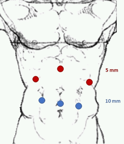 The umbilical port was extended for specimen extraction