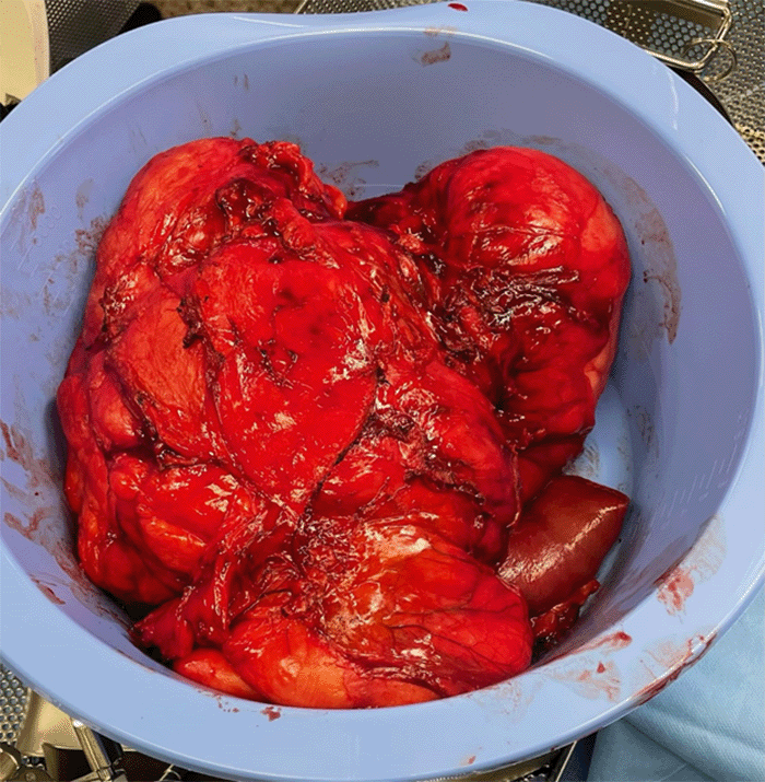 Retroperitoneal tumor, uncinate process of the pancreas, and a portion of the duodenum