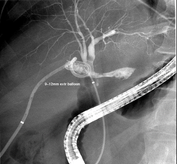 Figure 4. A PTBD was placed into the posterior sectional duct with its tip situated in the biliary hilum (thin arrow) and the subhepatic pigtail drain was removed. A CBD stent is in place (thick arrow). 