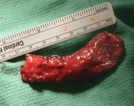 Figure 7. The resected diverticulum, measuring 7.2cm in length.