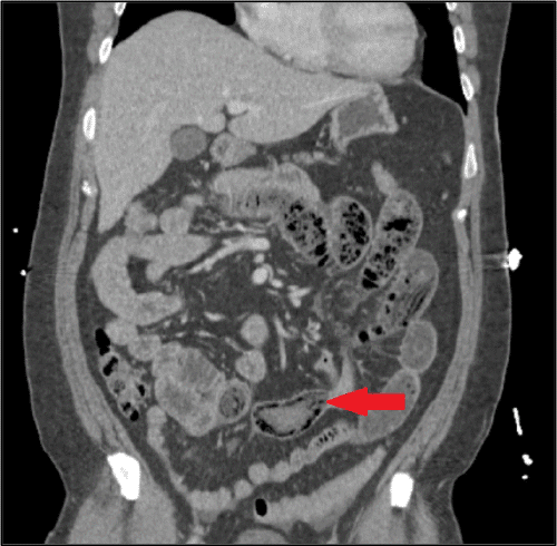 Red arrow points to an obstructing intraluminal mass in the distal small bowel