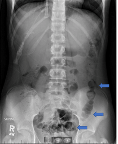 A Unique Presentation of Sepsis in a Pediatric Patient with Acute