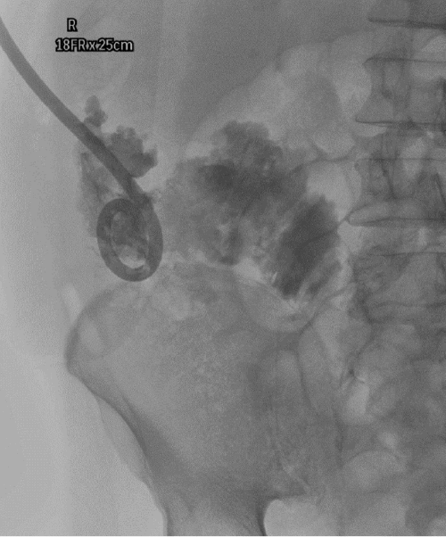 Image obtained during IR placement of a percutaneous drain under fluoroscopic guidance. The catheter is seen being advanced into the large right retroperitoneal fluid collection for initial source control