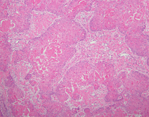 A, 100x) Dense clusters of squamous cells characterize the PTT