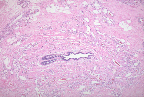 A) 4x: H&E stain with increased cellularity and vasculature infiltrating ductal breast tissue