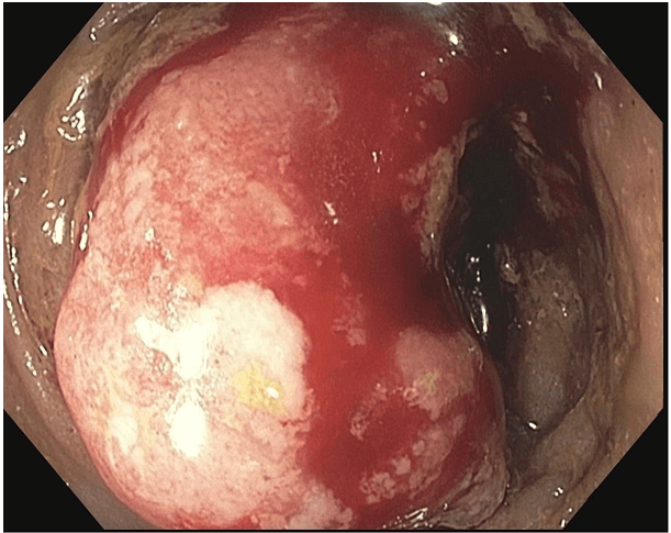 Figure 3. Endoscopic appearance of near circumferential, fungating and friable sigmoid mass.