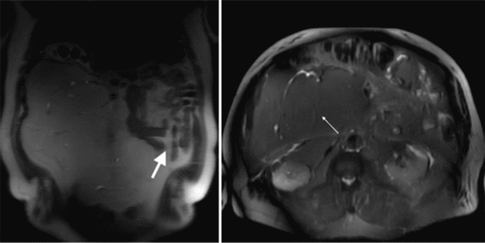 Large white arrow: Denotes small bowel compression due to mass effect. Small white arrow: Denotes a large retroperitoneal tumor with internal septations