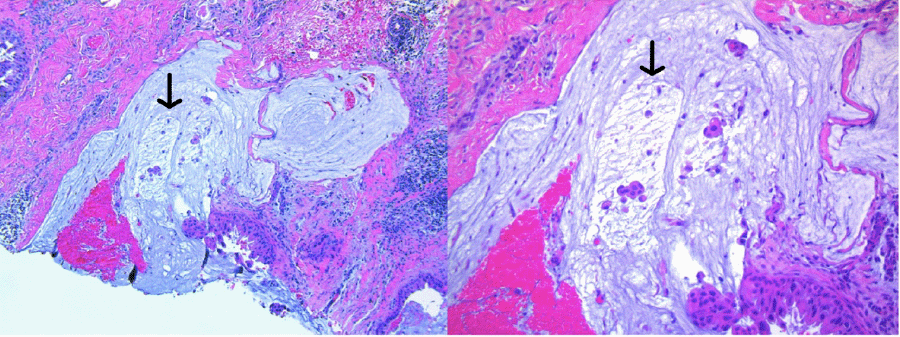 Pure mucinous carcinoma 10x (left) and 20x (right)