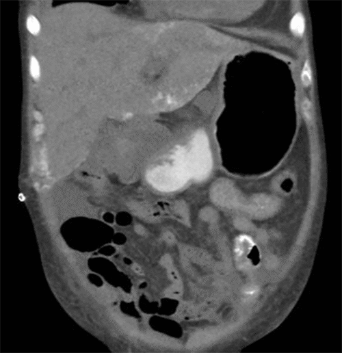 Heterogeneous calcifications involving the right upper quadrant (RUQ) liver periphery and adjacent abdominal wall are evident, near the incision site with visible skin staples. Additional findings include ascites and anasarca