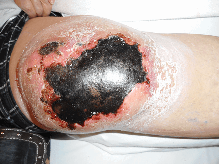 Figure 4. Right knee hematoma at presentation