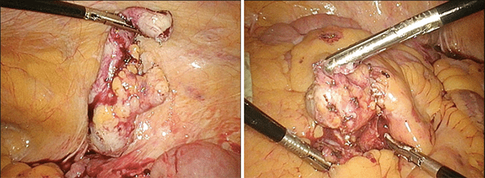 (A) Mass-like dilation of the tip of the appendix; (B) Enlarged ileocolic mesenteric lymph node adjacent to the appendix