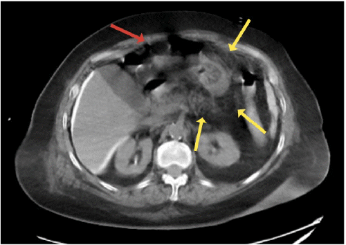 A) Intraperitoneal free air (red arrow) and diffuse peritoneal contrast extravasation (yellow arrows)
