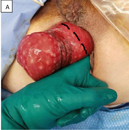 The sulcus sign is visualized as a circumferential space between the colon wall and anus. The dentate line is in the anatomic position, distinguishing this from rectal prolapse. The black dashed line indicates the planned transanal resection site