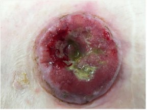 Figure 1. Stoma recurrence, preoperative