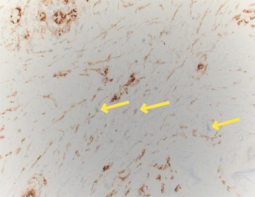 D) Beta-catenin immunohistochemical staining demonstrates normal cytoplasmic reactivity with a lack of nuclear staining in the spindle cells of interest (arrows)