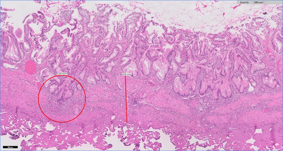 Gallbladder wall measuring 0.3 cm with apparent thickening of the muscularis marked by line. Presence of Rokitansky-Aschoff sinuses circled.