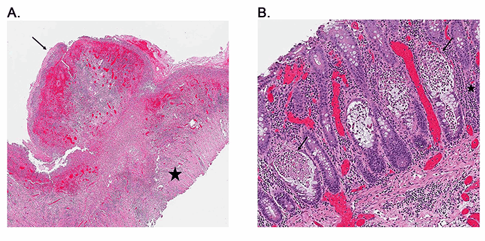 Figure 2. Pathologic analysis indicates immune-mediated colitis. A. Path Low power hematoxylin and eosin (H&E) image showing sigmoid colon with extensive ulceration and full-thickness necrosis extending from the mucosa (arrow) into the muscularis propria (star). B. Medium power hematoxylin and eosin (H&E) image showing colonic glands with acute inflammation, crypt abscesses (arrows), scattered enterocyte apoptosis, and mild lymphoplasmacytic expansion of the lamina propria (star).