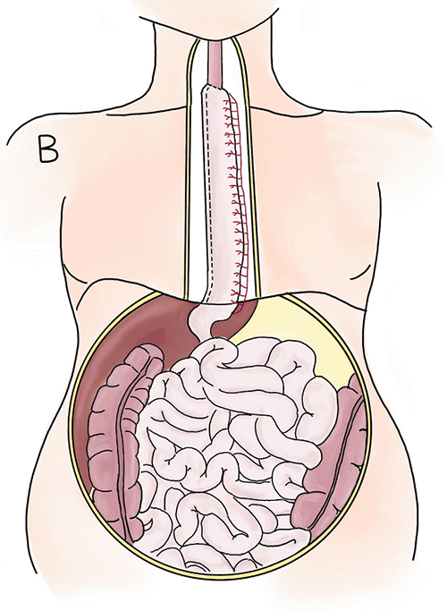B) Postoperative: Following minimally invasive modified McKeown laparoscopic esophagectomy (MIE), the tumor is resected, the gastric conduit is transposed into the thoracic cavity, and an esophagogastric anastomosis is created in the neck.