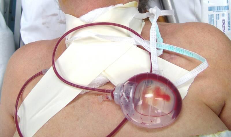 cigarette drain surgery Your Surgical Drain cigarette drain surgery Your Surgical Drain