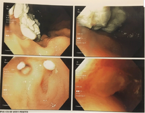 Image depicting retained food in stomach. Patient's last solid meal was 23 hours prior