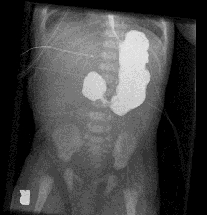 Figure 2. Bedside contrast study postesophageal repair demonstrating failure of contrast to pass beyond into the proximal duodenum, consistent with duodenal atresia. 