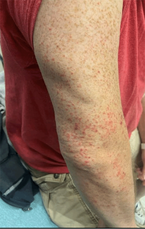 Clinical photographs illustrating the characteristic palpable purpuric rash associated with IgA vasculitis, distributed over the upper and lower extremities