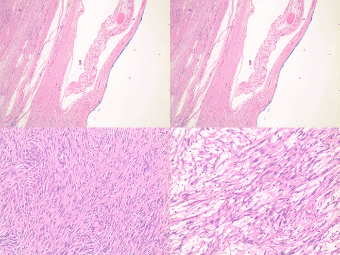 Figure 3. Nerve fiber seen wrapping lesion peripherally (a) spindle cells with palisading nuclei (b) Antoni A with high cellularity (c) Antoni B with loose cellularity (d)