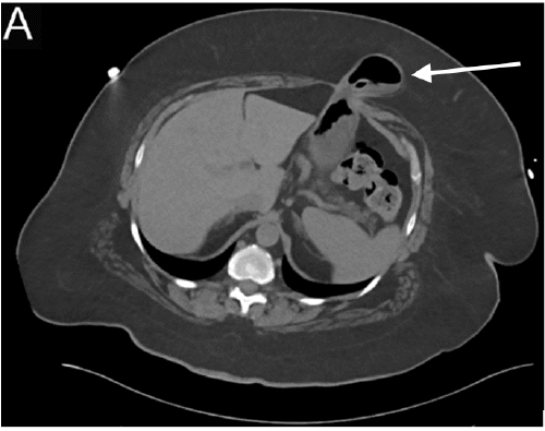 A) Axial slices demonstrating gastric hernia (arrow); the gastrostomy tube is visualized