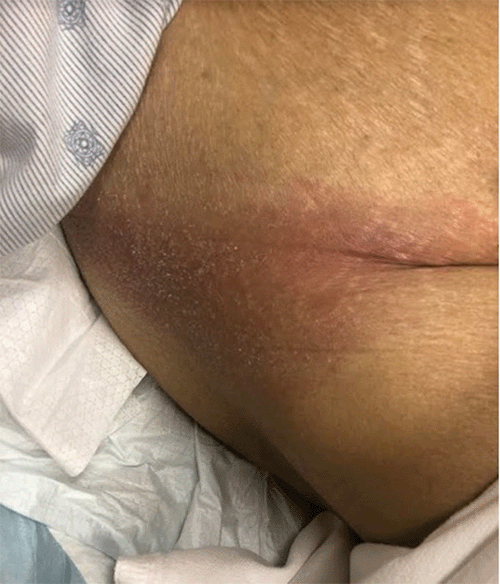 Mild erythema over the patient’s right groin extending laterally, seen on presentation