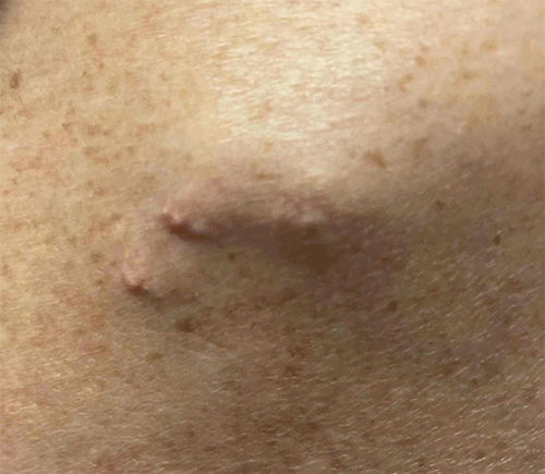 Close-up view reveals a cluster of six 3 mm white-yellow papules with surrounding erythema. The papules appear firm and tender upon palpation