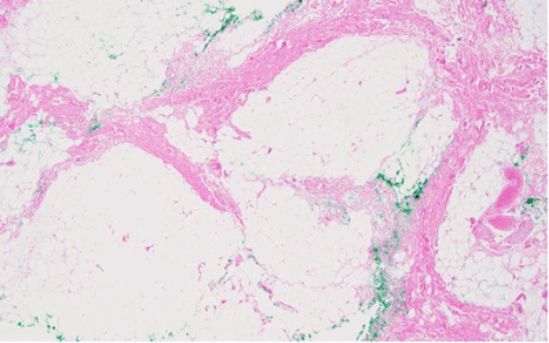 H&E stain (40x original magnification) showing lobules of adipocytic cells in varying stages of maturation, separated by fibrous bands