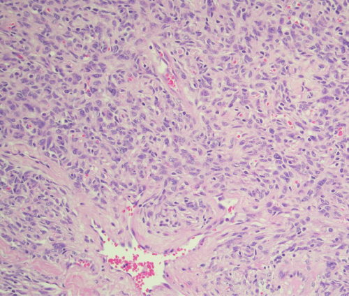 H&E stain, 20x original magnification illustrating the classic “patternless pattern” of the solitary fibrous tumor. Note the relatively uniform spindle cells, some with an epithelioid appearance, interspersed with prominent, branching, “staghorn” or hemangiopericytoma-like blood vessels, and areas of extravasated red blood cells within a collagenous stroma