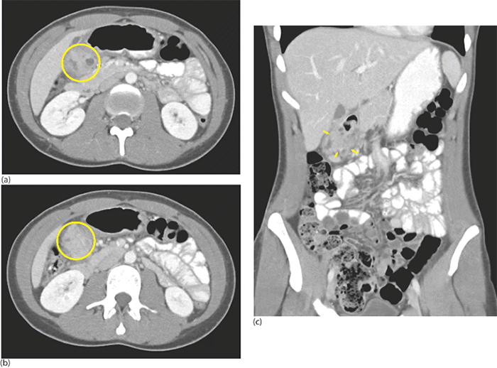 Panel A (axial view, cephalad perspective) and Panel B (axial view) show a mass encircling the pylorus and duodenum (yellow circle). Panel C (sagittal view) highlights the mass with yellow arrows. However, the CT findings were inconclusive, and the differential diagnosis included duodenal ulcer disease with penetration, leiomyoma, atypical gastrointestinal stromal tumor (GIST), focal pancreatitis, or annular pancreas