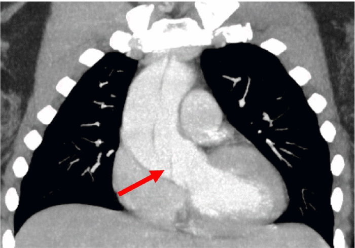 Stanford Type A aortic dissection originating at the sinotubular junction and extending distally through the aortic arch and into the descending aorta
