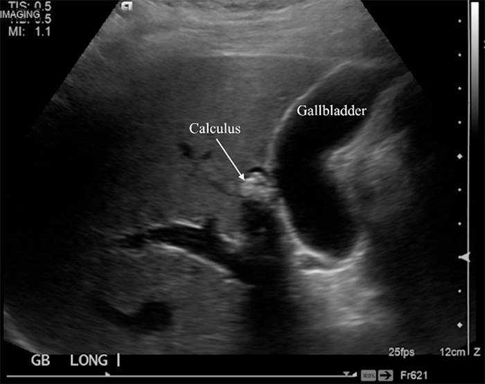 Indocyanine Green FluorescenceGuided Laparoscopic Cholecystectomy with Right Trabecular