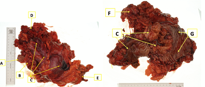 Components are labeled as follows: (A) overlying skin ellipse, (B) segment of rectus abdominis muscle invaded by tumor, (C) the exophytic and invasive colonic adenocarcinoma, (D) proximal colonic resection margin, (E) distal colonic resection margin, (F) resected mesentery containing the vascular pedicle and lymph nodes, and (G) an opened segment of adjacent, uninvolved colon demonstrating healthy plicae circulares. The specimen illustrates the full-thickness involvement of the abdominal wall by the tumor.