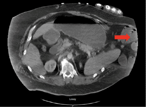 Axial view from the initial abdominal CT scan on presentation. The images demonstrate a large, left-sided lateral ventral hernia containing bowel loops. Note the incomplete visualization of the entire hernia sac due to the patient’s body habitus, with possible early fluid accumulation noted near the subcostal margin (arrow)