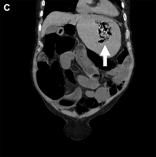 C) Coronal view, anterior