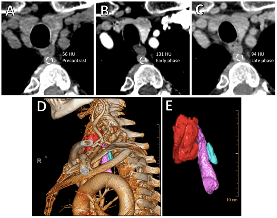 A) 11 × 12 × 21 mm mass measuring 56HU on non-contrast imaging was noted posterior to the upper esophagus, B) which enhanced to 131 HU on arterial phase, and C) washed out to 94 HU on late phase. D and E) 4D-CT rendering images demonstrated the enlarged retroesophageal mass (light blue mass; thyroid gland indicated in red, esophagus in lavender).