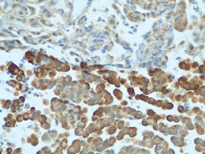 Figure 3. Primary goblet cell carcinoid tumor staining positive for synaptophysin