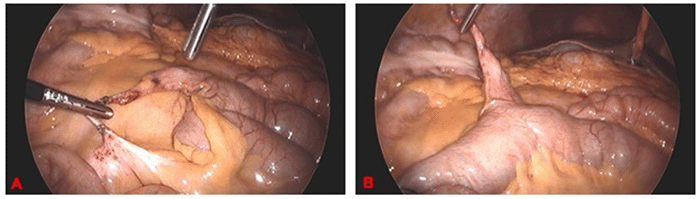 Adhesive band originating from Meckel’s diverticulum and extending to the small bowel mesentery. In the initial view (A), the band forms an internal hernia, entrapping small bowel loops. Subsequent to division (B), the hernia is resolved
