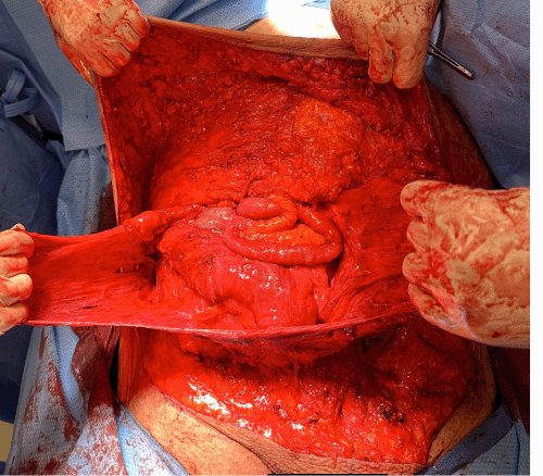 Intraoperative photograph after opening the hernia sac, illustrating the extensive 15 × 15 cm fascial defect with herniated bowel visible
