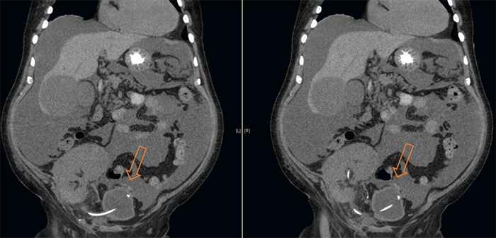 The kidney transplant graft, ureteral stent, and bladder can be appreciated. The arrow indicates where the bladder perforation was found; in retrospect, a clot was in that area (found during laparoscopy).