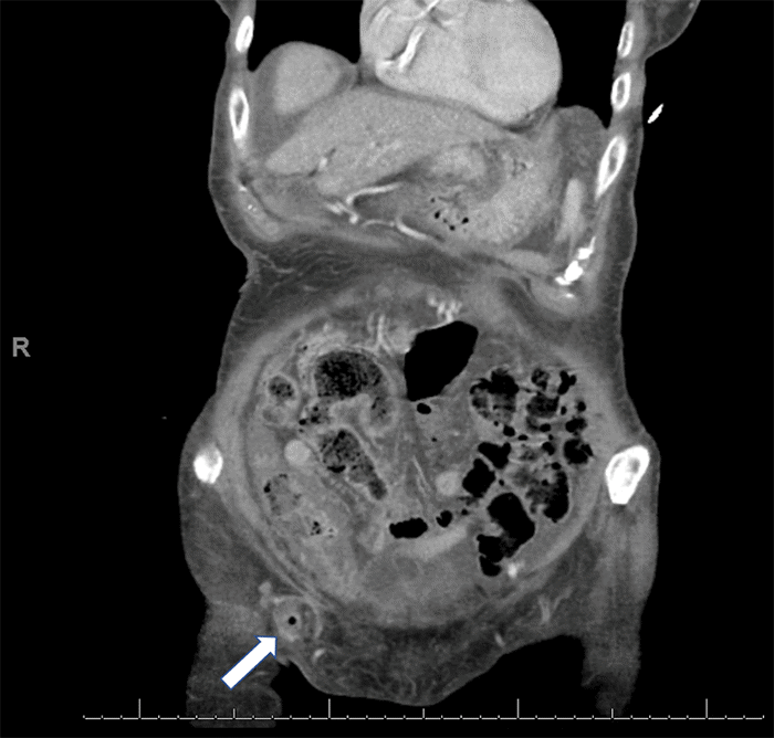 Fat and fluid content within the hernia sac are evident in the right lower quadrant (arrow). The appendix is visualized within the hernia sac, closely approximating the inguinal ligament