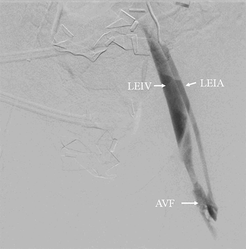 Figure 2. Left sided arteriovenous fistula between common femoral artery and vein. Arterial injection during angiogram reveals contrast in the external iliac artery, through the fistula, and into the common femoral vein, with no contrast in the distal artery. LEIV=left external iliac vein; LEIA=left external iliac artery; AVF=arteriovenous fistula.
