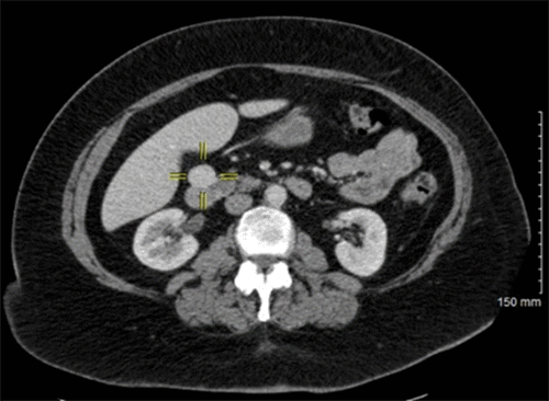 Image depicts well-circumscribed nodular hypervascular enhancing mass of the pancreatic head, later found on surgical pathology to represent nonfunctional neuroendocrine tumor of the pancreas