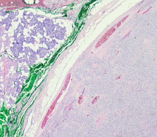 H&E stain, 5x original magnification of the resected parotid tumor. The image shows benign salivary gland acini and adipose tissue (left side of field) adjacent to the spindle cell lesion (right side of field), which exhibits a circumscribed, “pushing” border against the normal parotid parenchyma