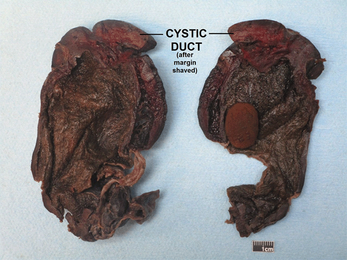 The cystic duct measured 2.7 cm and was thickened, firm, and with no obvious patent lumen