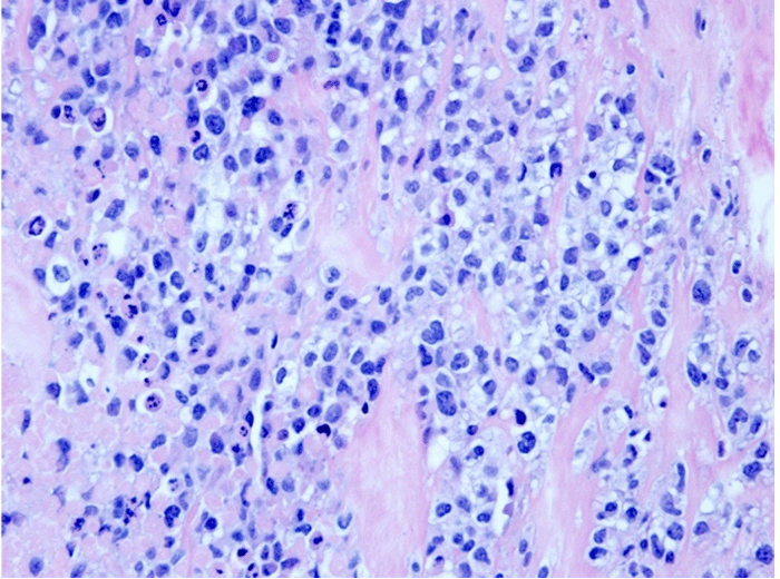 Higher magnification image (40x) showing numerous atypical/pleomorphic tumor cells, including occasional horseshoe/kidney-shaped Reniform cells with prominent Golgi eosinophilic material and many single apoptotic cells (hematoxylin and eosin stain)