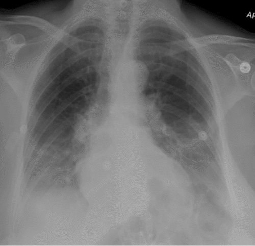B) Review of chest X ray from five days earlier demonstrated normal findings